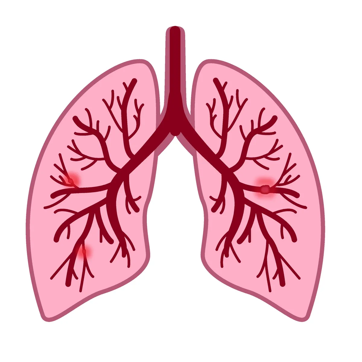 Angio-TK w diagnostyce zatorowości płucnej – skrzeplina w świetle tętnicy płucnej i ocena miąższu płuc