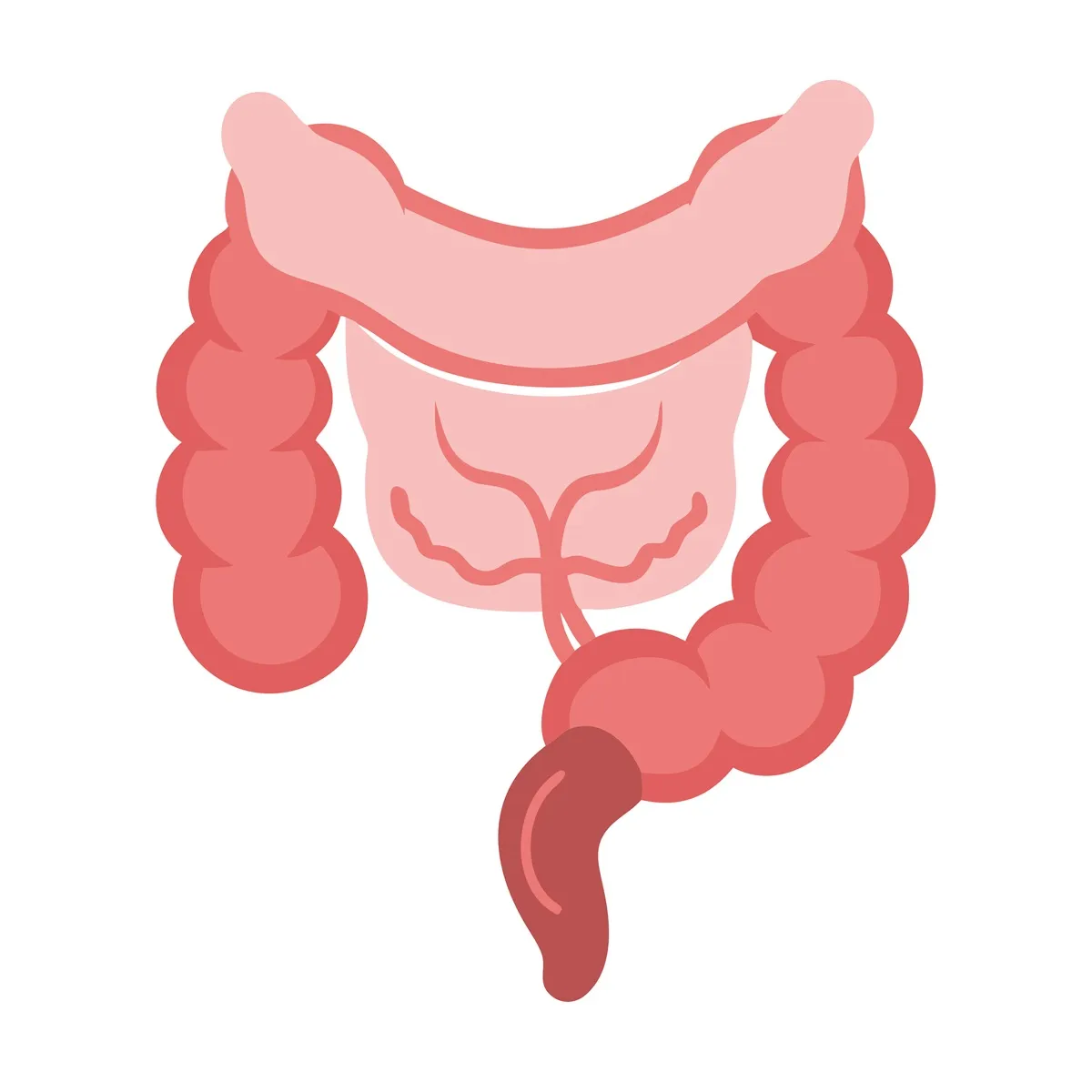 Powikłania perforacji wyrostka i martwicy odcinka ściany wyrostka mogą prowadzić do rozlanego zapalenia otrzewnej i stanu bezpośredniego zagrożenia życia