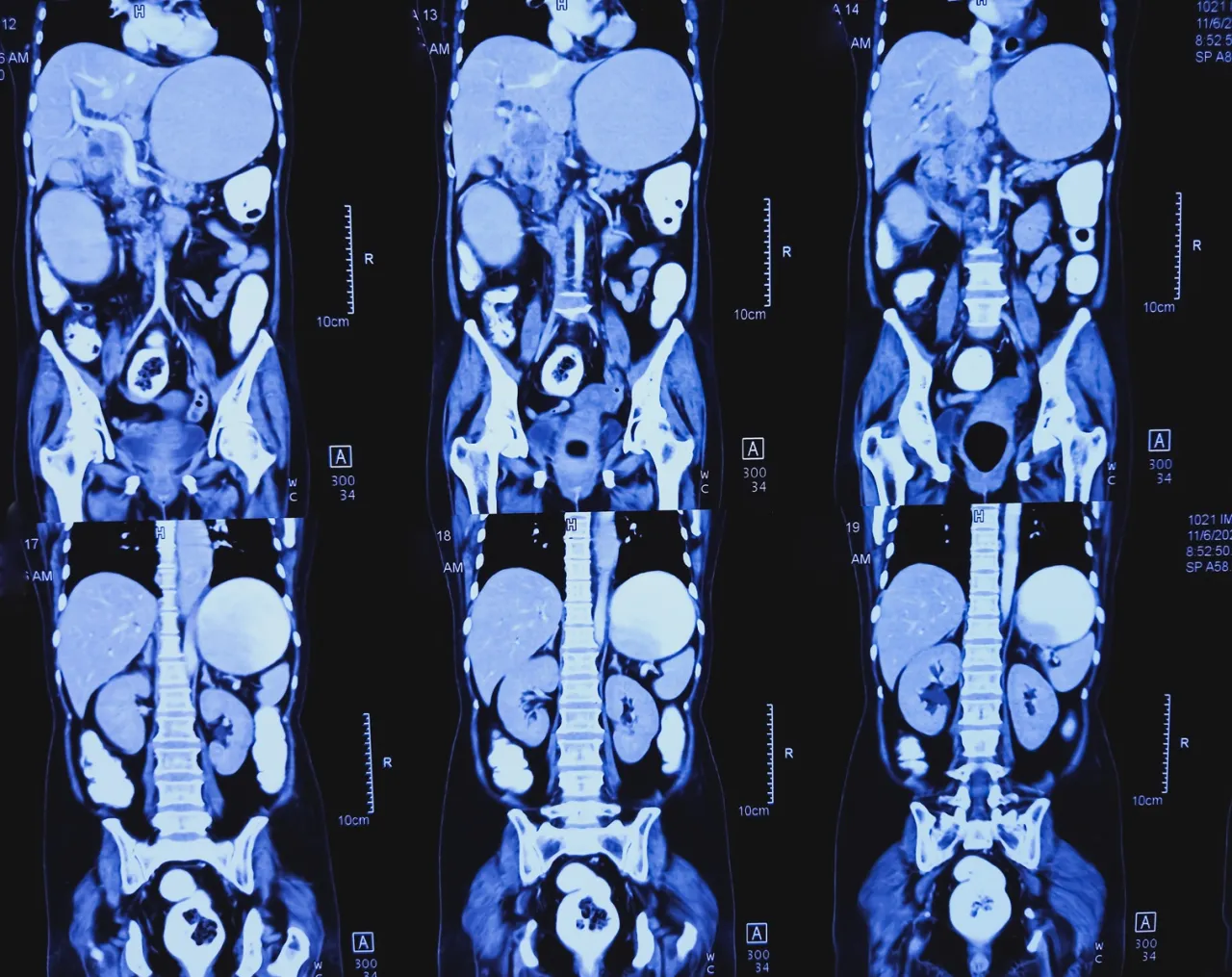 TK jamy brzusznej: tomografia komputerowa – w jamie brzusznej stwierdza cechy procesu zapalnego, podejrzenie ropnia okołowyrostkowego