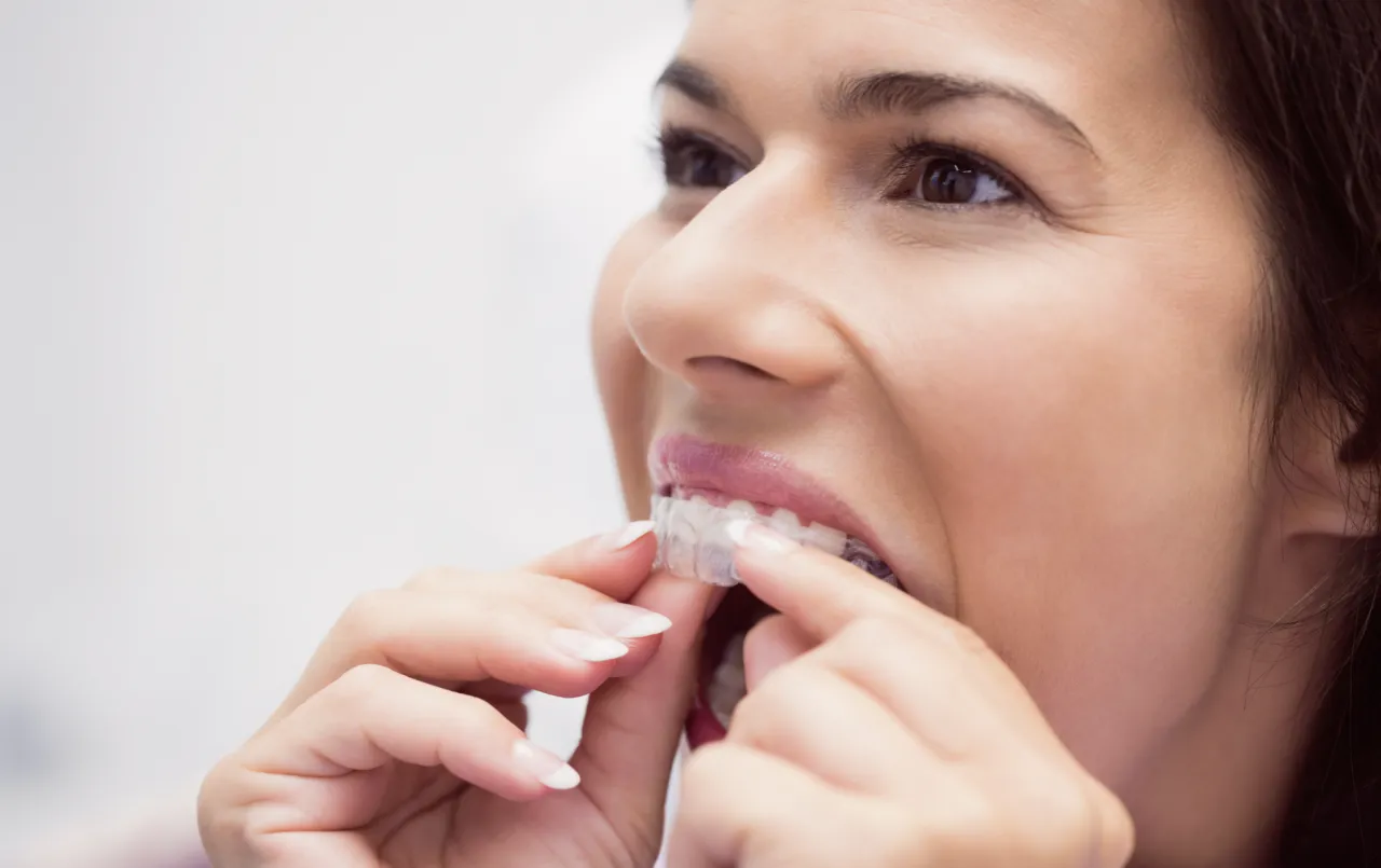 nakładki Invisalign