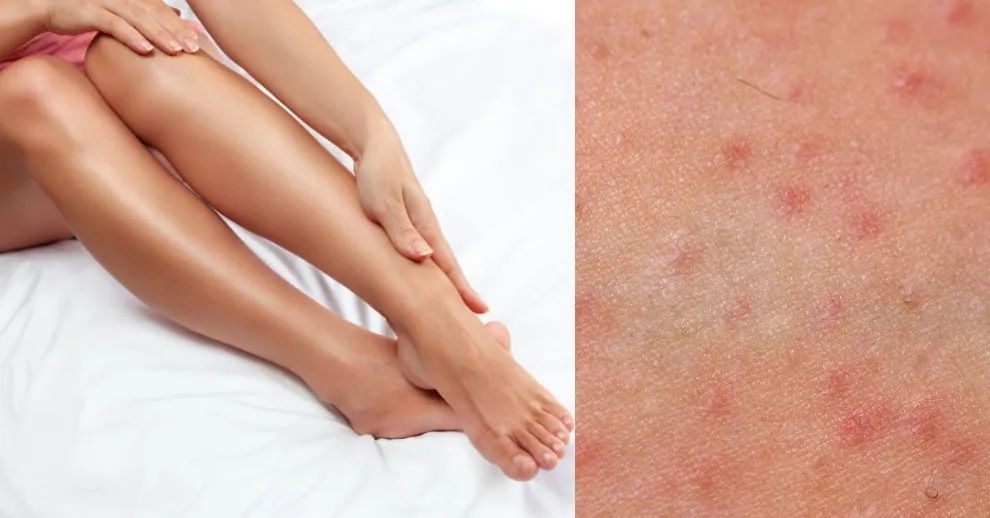 Domowe sposoby na krostki po goleniu