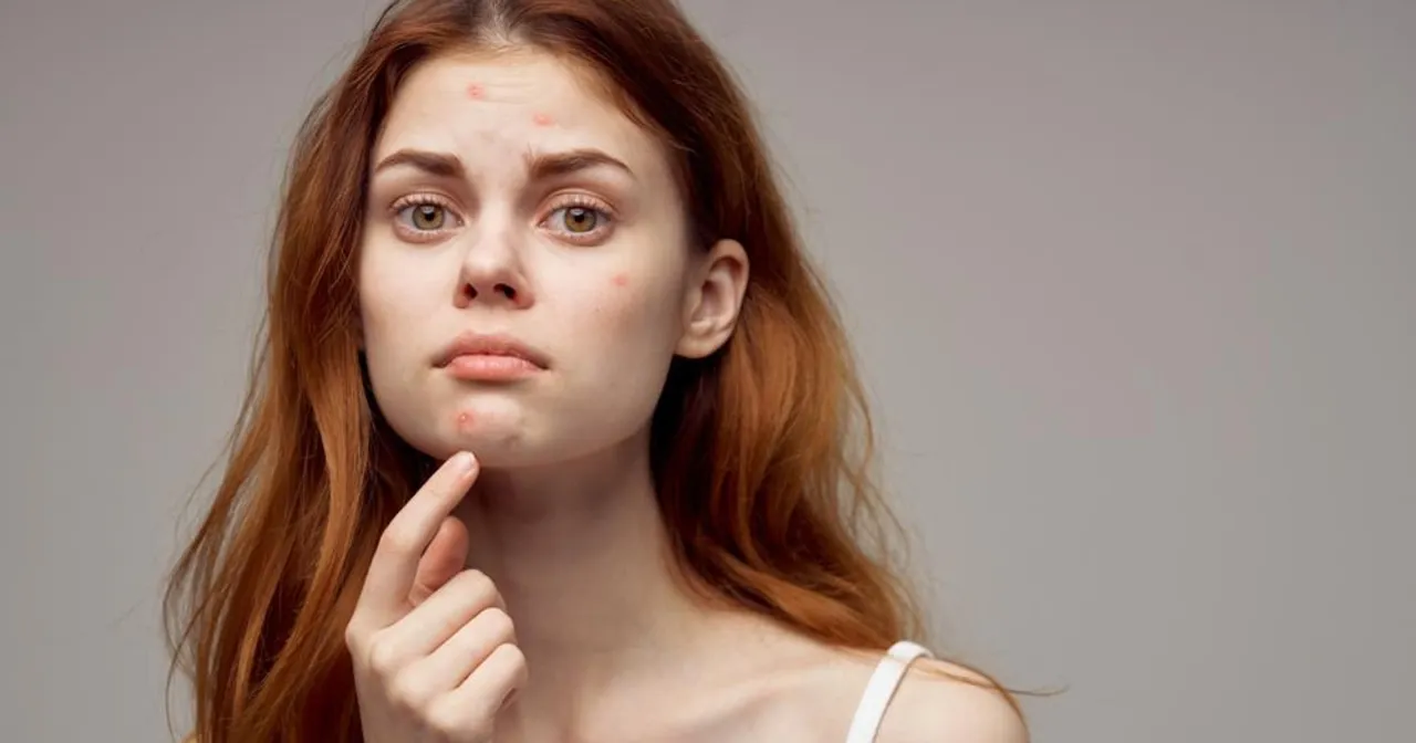 Zmarszczki i pryszcze na twarzy rudowłosej kobiety. Szuka sposobu, jak pozbyć się pryszczy w kilka godzin.