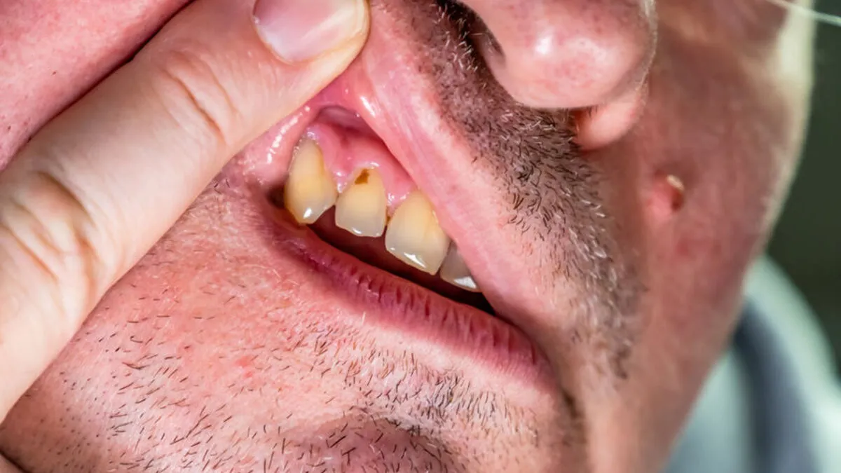 sygnały alarmowe ból zęba, obrzęk twarzy, ropień dziąsła