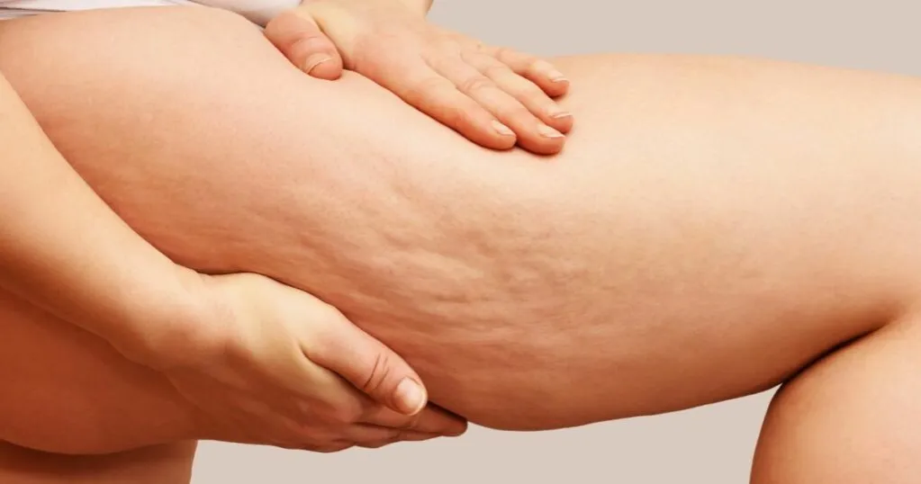 cellulit rodzaje i przyczyny