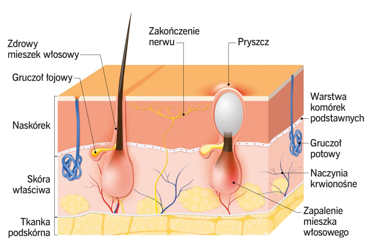 schemat powstawania pryszczy
