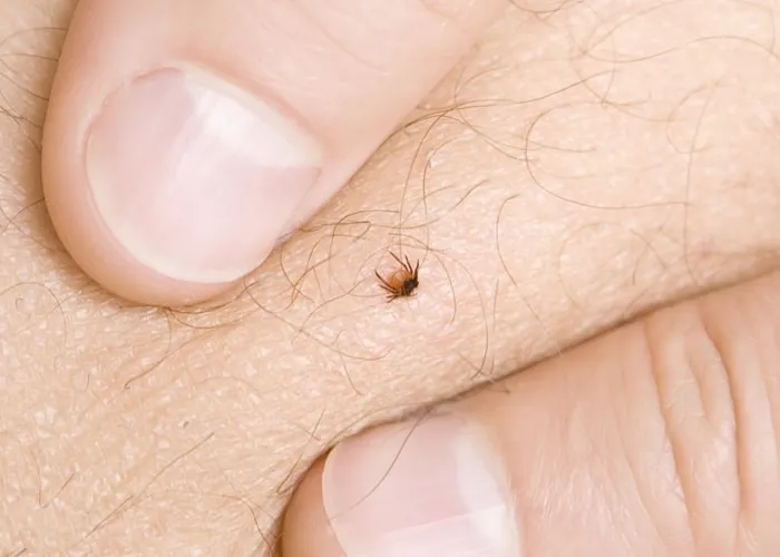 kleszcz wbity w sk&oacute;rę