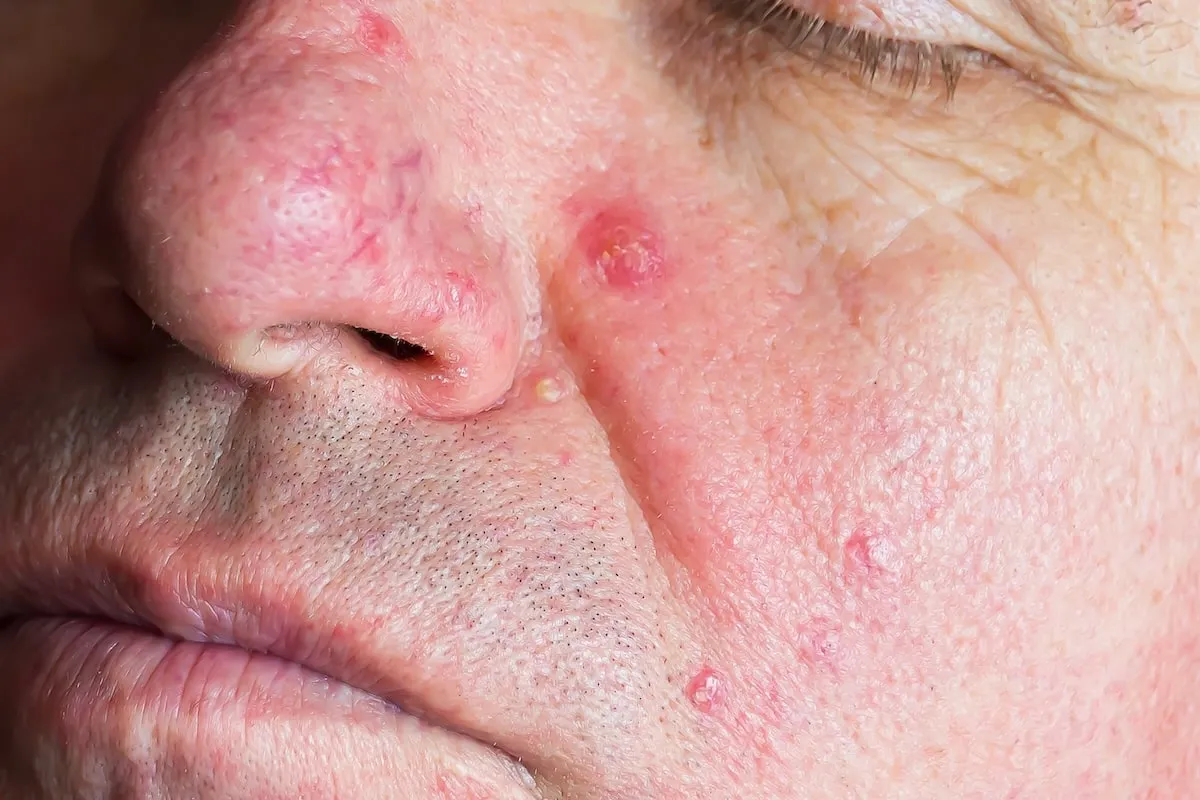 Czynniki wpływające na powstawanie pryszczy na nosie