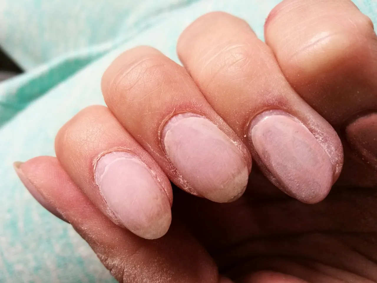 problemy z przedłużonymi paznokciami zapowietrzenia pękanie uczulenie