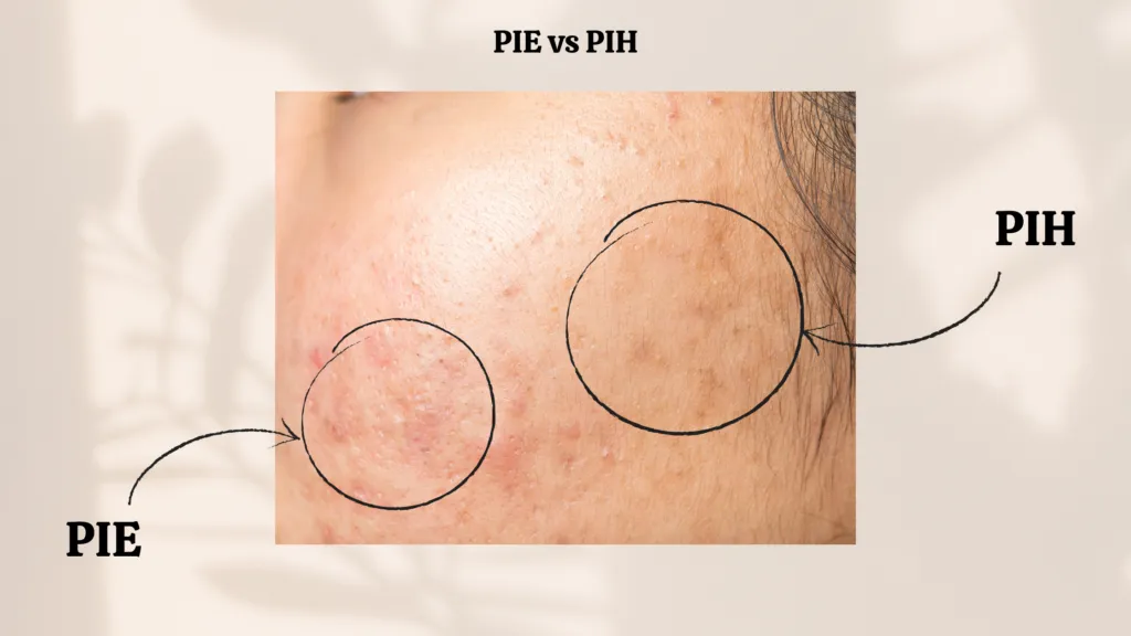 Czerwone ślady po pryszczach PIE vs brązowe przebarwienia PIH różnice