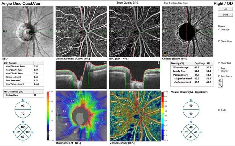 choroby siatk&oacute;wki oka OCT