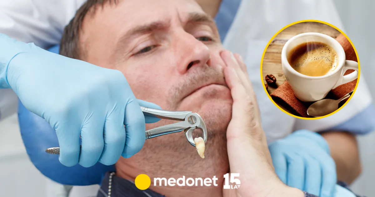 Zdjęcie Czy po wyrwaniu zęba można pić kawę? Oto, co musisz wiedzieć