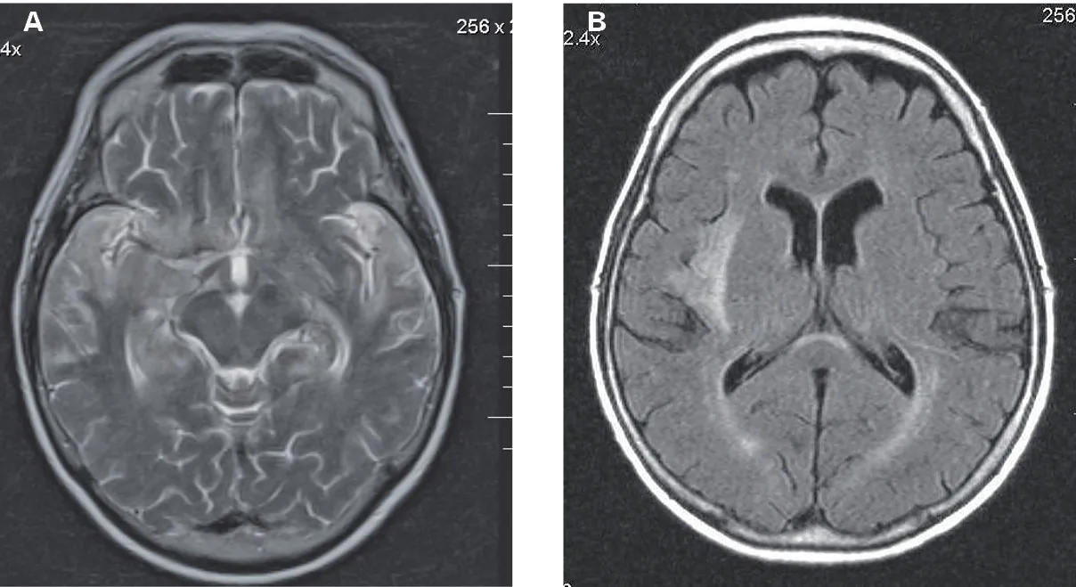 uszkodzenia mózgu po dopalaczach