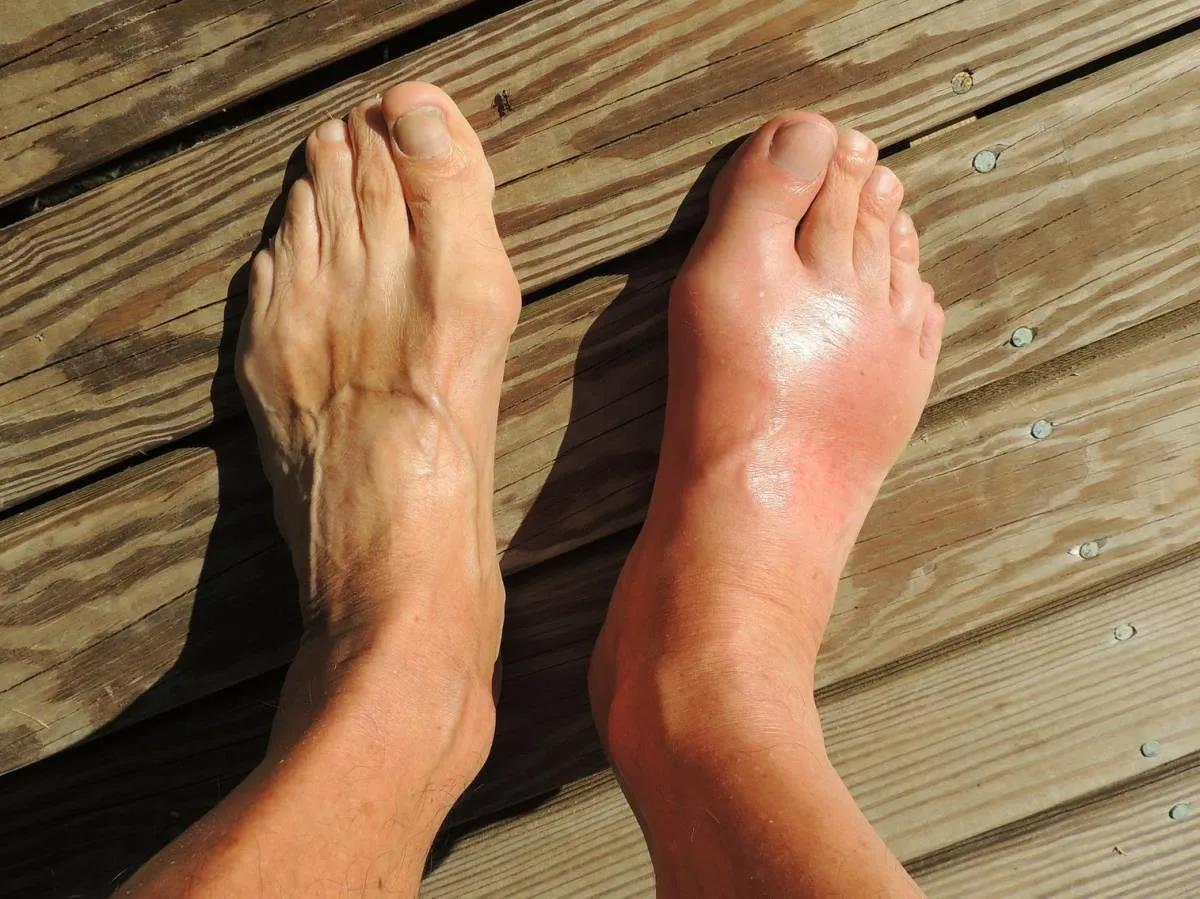 dna moczanowa kryształy w stawie