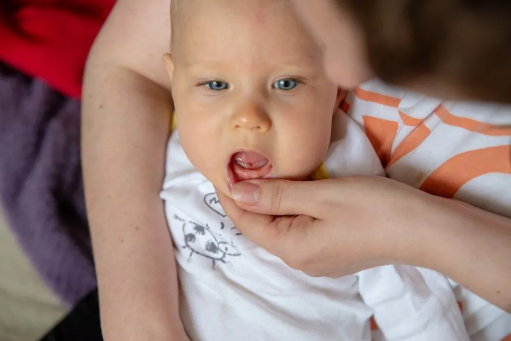 zaczerwienione opuchnięte dziąsła niemowlaka ząbkowanie