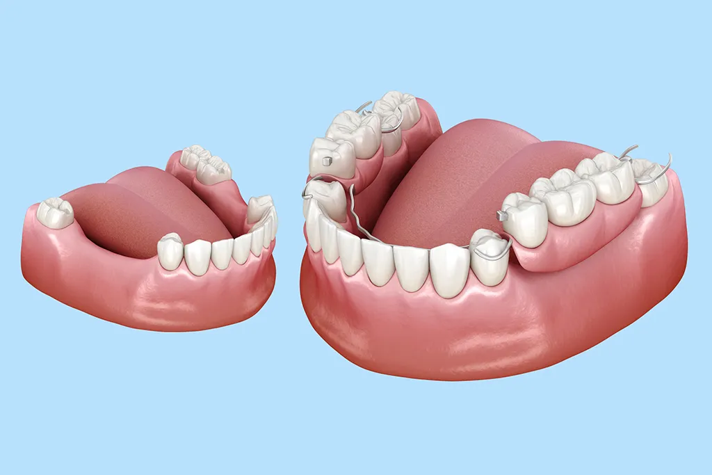 różne metody uzupełniania braków zębowych porównanie