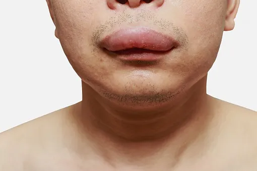 obrzęk naczynioruchowy twarzy zdjęcia