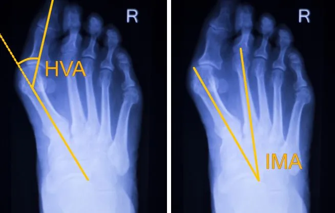 ortopeda badanie stopy RTG haluksy