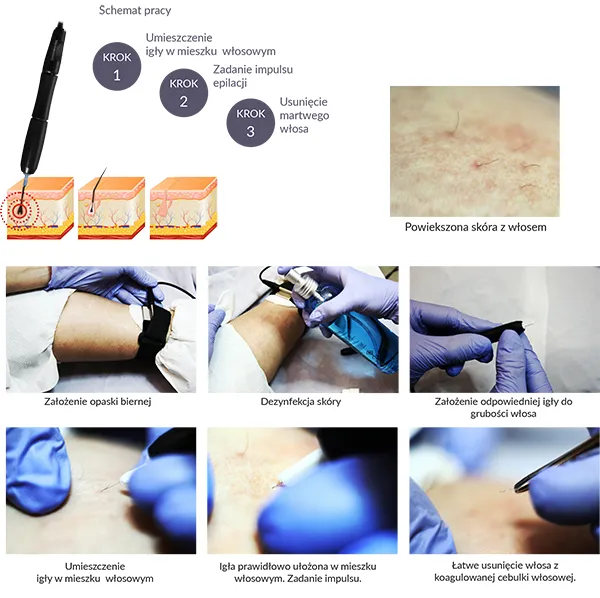 Elektroepilacja metody działania schemat