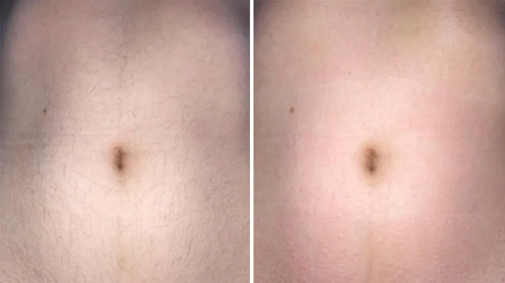 Porównanie metod depilacji brzucha