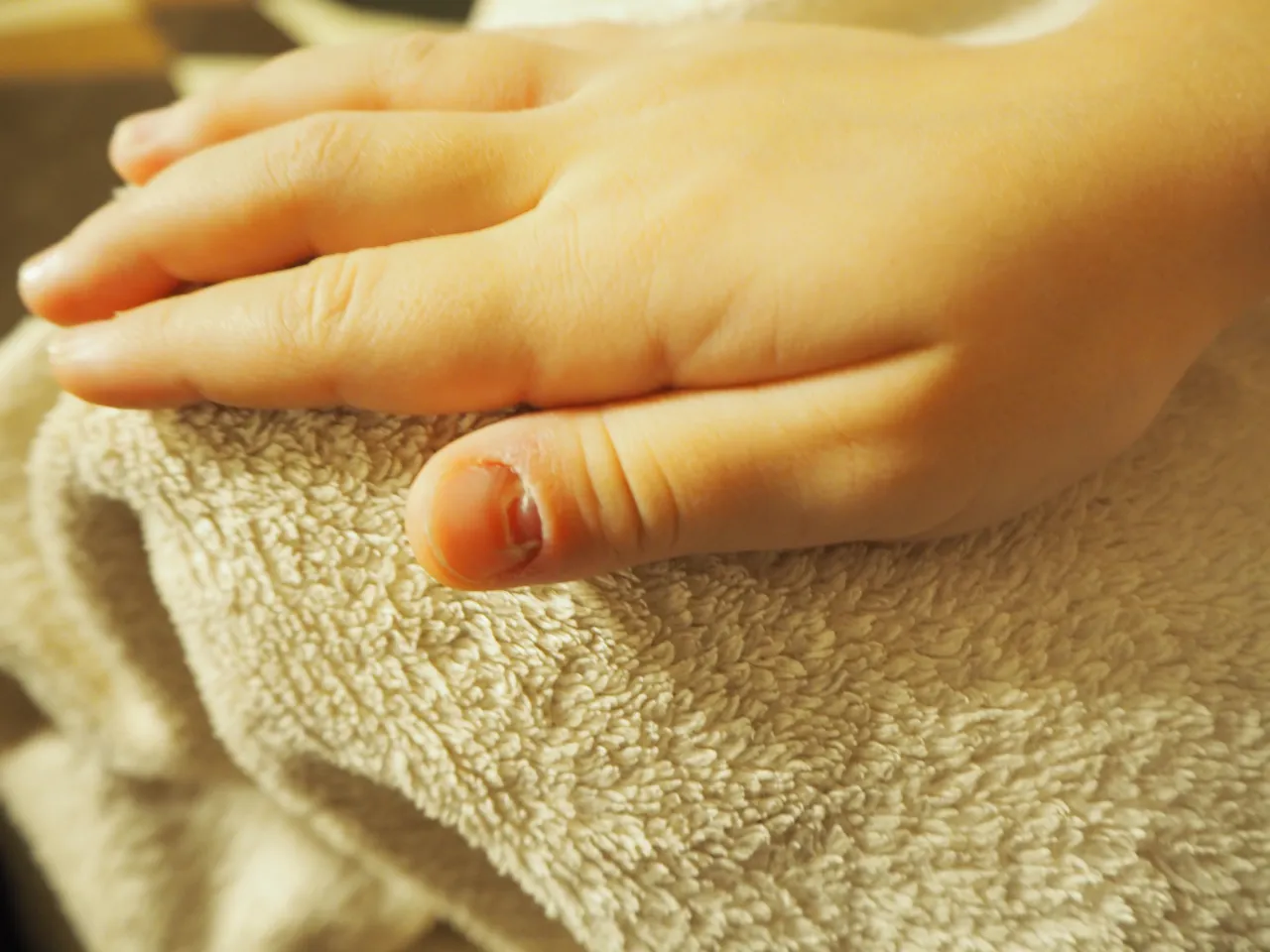 pierwsza pomoc przytrzaśnięty palec