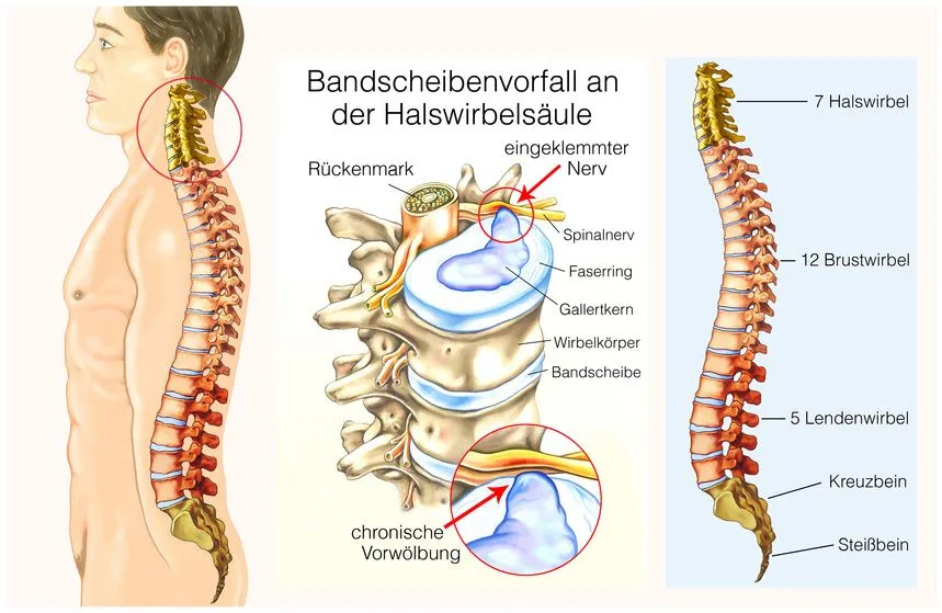 Anatomie Halswirbels&auml;ule Nervenkompression