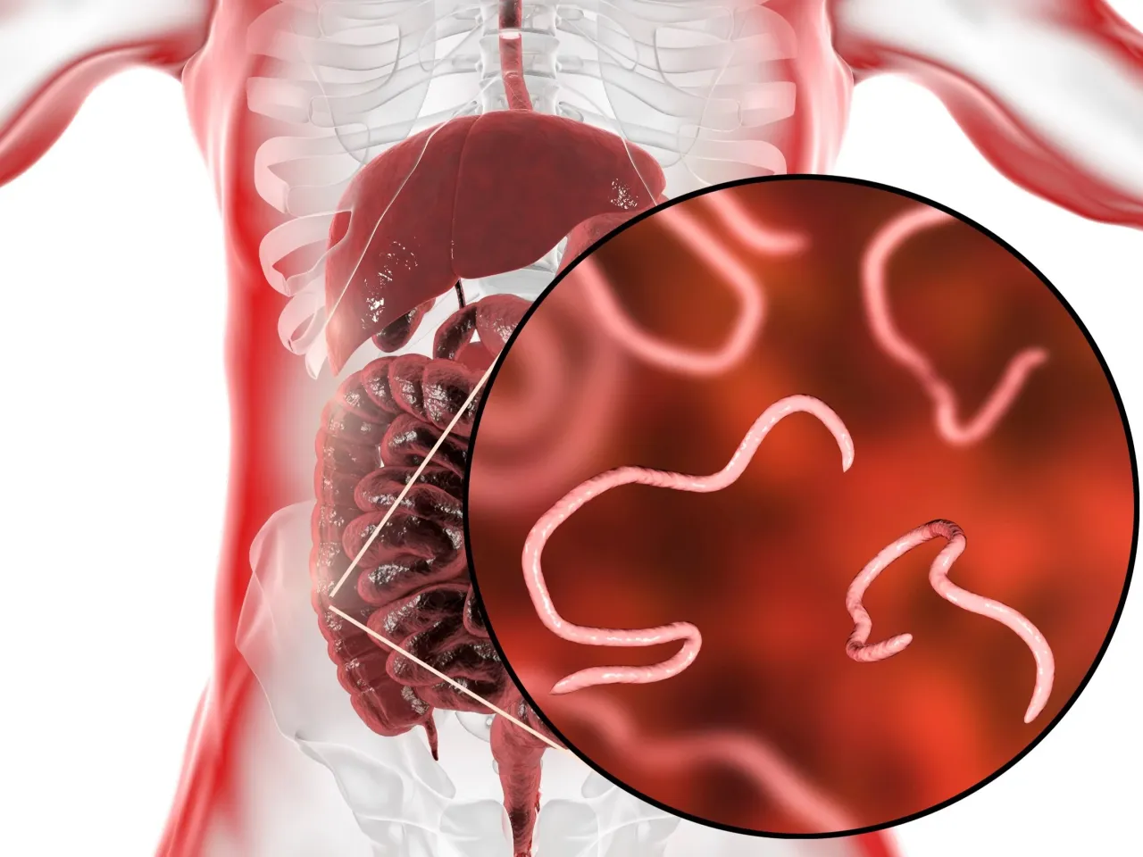 Owsica u dorosłych objawy