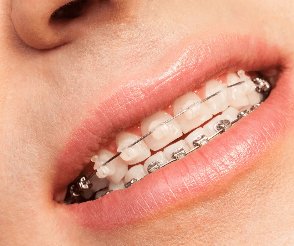 aparat estetyczny ceramiczny szafirowy na zębach