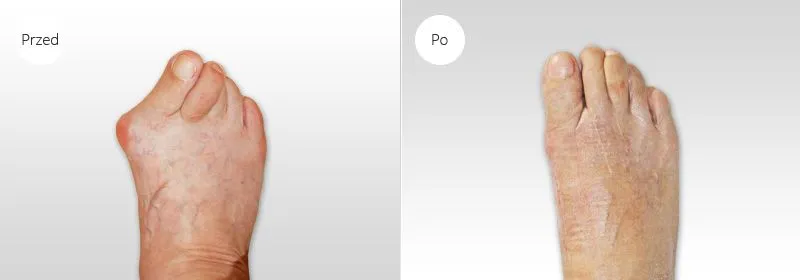 operacja haluksa przed po