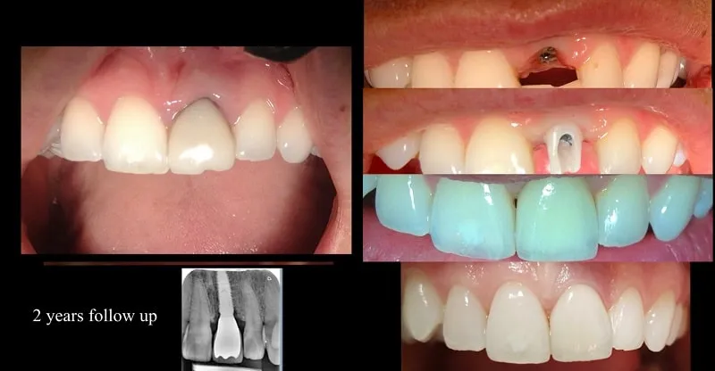 metody odbudowy zęba jedynki porównanie