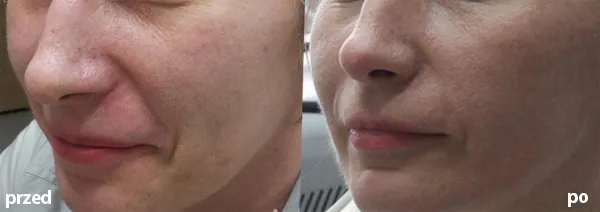 kiedy makijaż po laserze frakcyjnym co2 nieablacyjnym