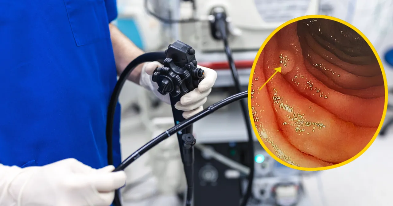 Polipy jelita grubego kolonoskopia