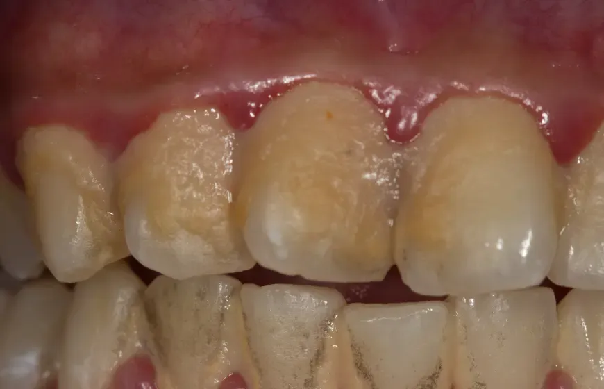 Zniszczone zęby po narkotykach