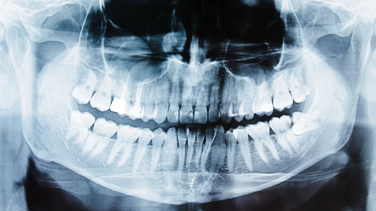 zdjęcie RTG korzenia zęba w dziąśle
