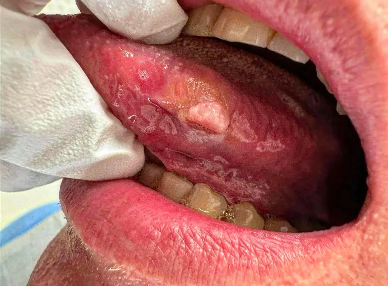 rak płaskonabłonkowy jamy ustnej objawy zdjęcia