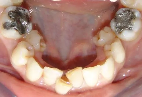 przedtrzonowce zęby ekstrakcja ortodoncja stłoczenia