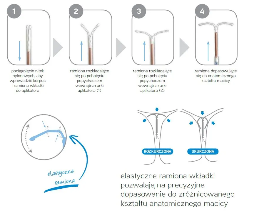 wkładka domaciczna miedziana schemat