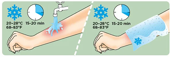 pierwsza pomoc po poparzeniu meduzą infografika