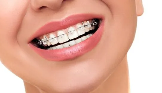 rodzaje aparatów ortodontycznych stały ruchomy