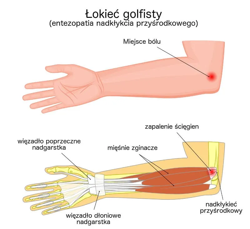 Łokieć golfisty anatomia ból nadkłykieć przyśrodkowy