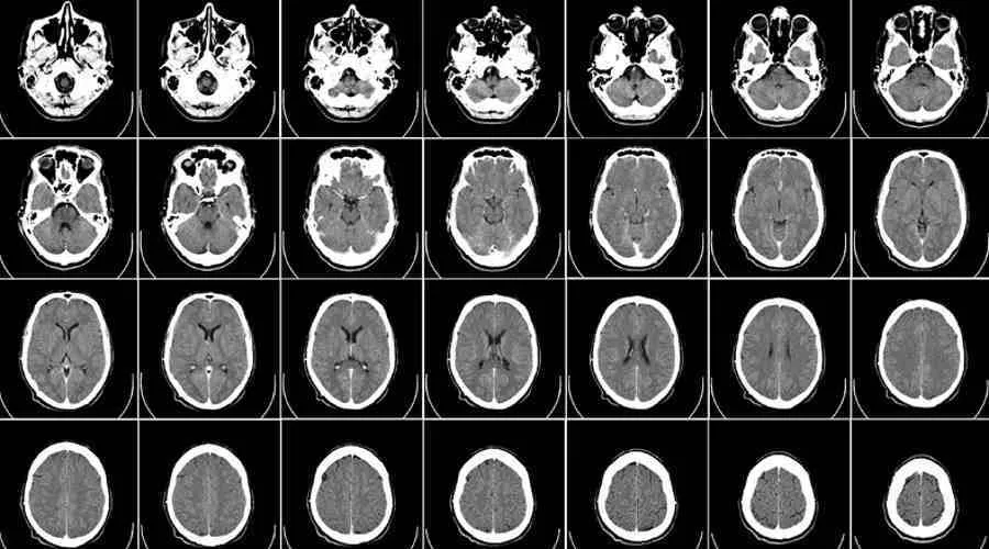 mózg ADHD rezonans obszary