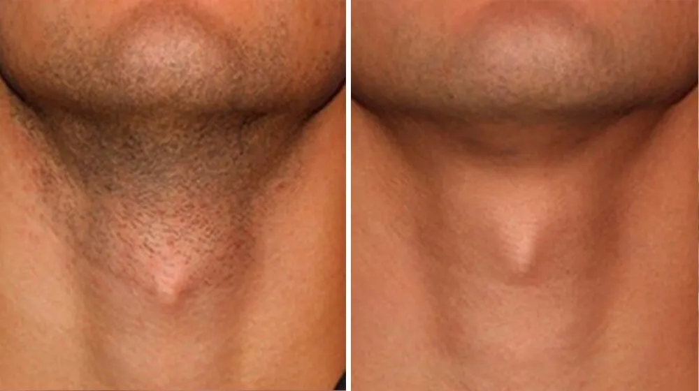 depilacja laserowa brody przed i po