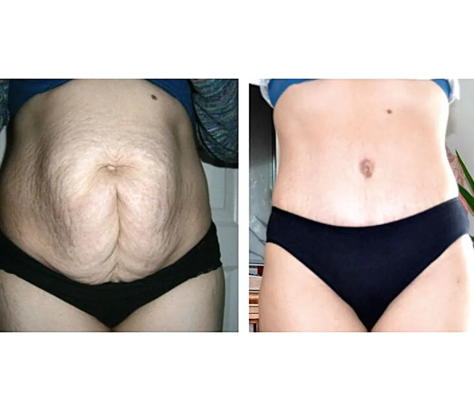 osoba pływająca po operacji brzucha