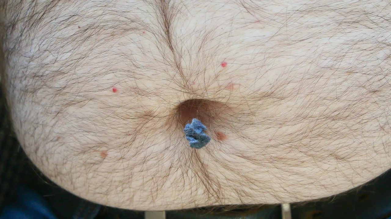 Wyczyszczenie pępka z kłębka niebieskiej waty. Kilka czerwonych kropek na skórze.