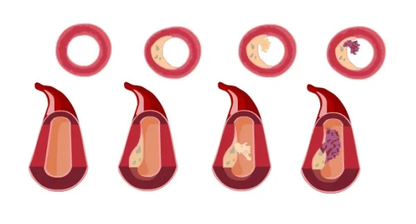 proces tworzenia blaszki miażdżycowej