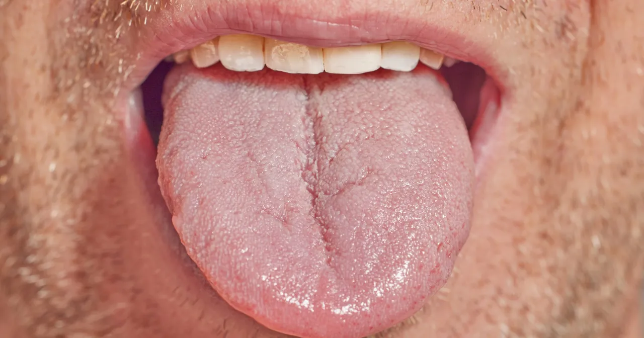 język z białym nalotem vs zdrowy język