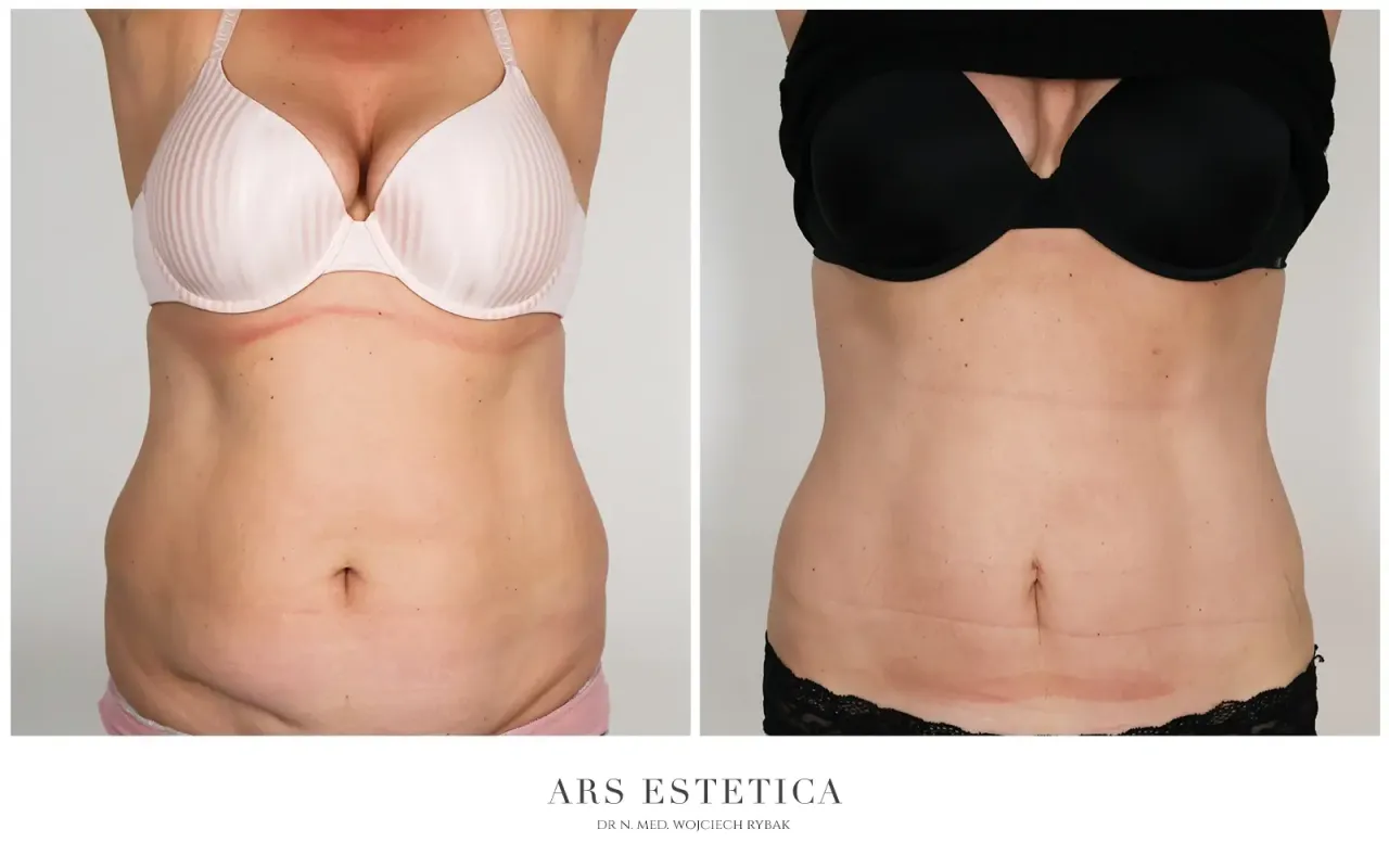 Liposukcja brzucha definicja modelowanie sylwetki
