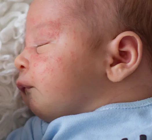 Skaza białkowa na policzkach niemowlaka