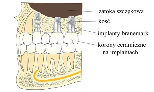regeneracja kości przed implantem schemat