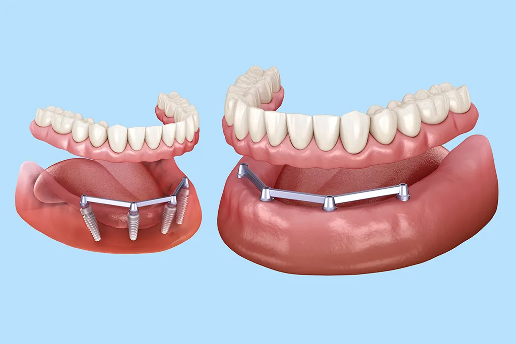 protezy akrylowe a nowoczesne w UV