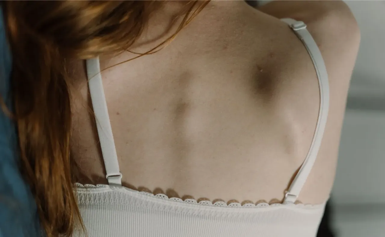 Profesjonalne zabiegi na trądzik na plecach